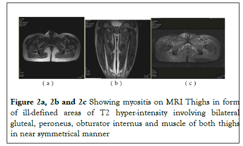 rheumatology-MRI Thighs